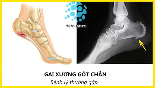 gai xương gót chân gây ra bệnh đau gót chân